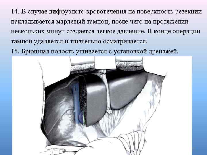14. В случае диффузного кровотечения на поверхность резекции накладывается марлевый тампон, после чего на