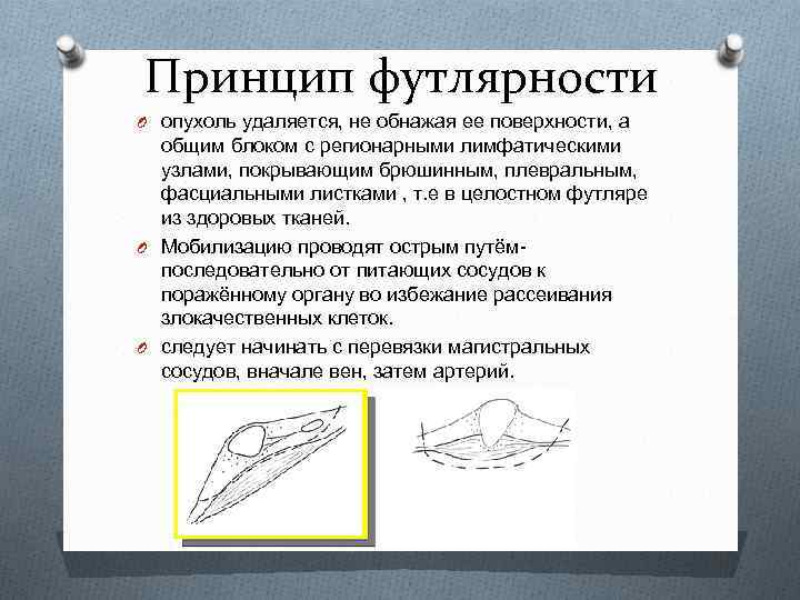 Абластика и антибластика в онкологии. Принцип футлярности. Принцип футлярности в онкологии. Принцип футлярности и зональности. Футлярность в хирургии.