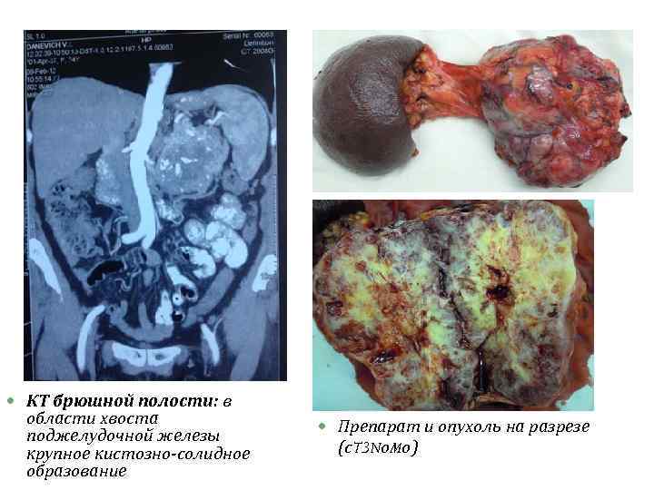  КТ брюшной полости: в области хвоста поджелудочной железы крупное кистозно-солидное образование Препарат и