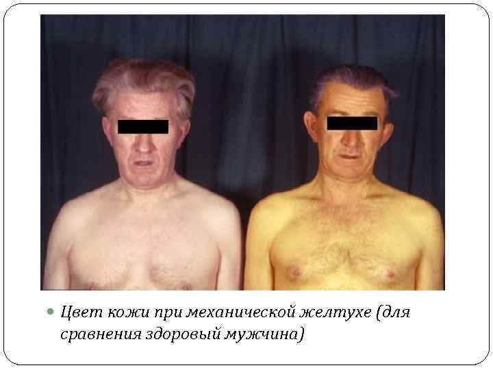  Цвет кожи при механической желтухе (для сравнения здоровый мужчина) 