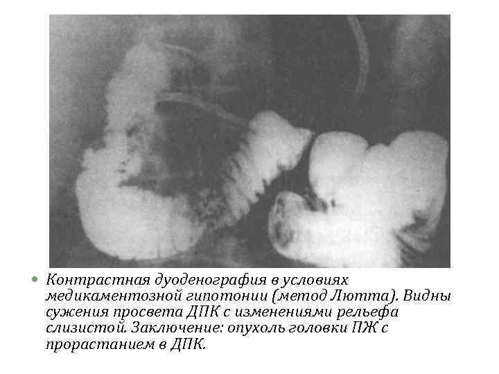  Контрастная дуоденография в условиях медикаментозной гипотонии (метод Лютта). Видны сужения просвета ДПК с
