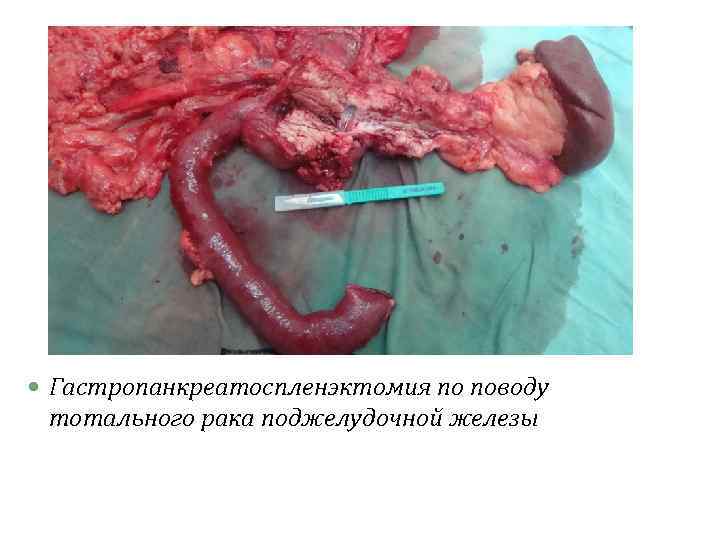  Гастропанкреатоспленэктомия по поводу тотального рака поджелудочной железы 