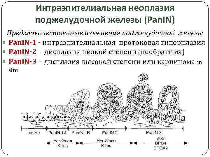 Интраэпителиальная неоплазия поджелудочной железы (Pan. IN) Предзлокачественные изменения поджелудочной железы Pan. IN-1 - интраэпителиальная