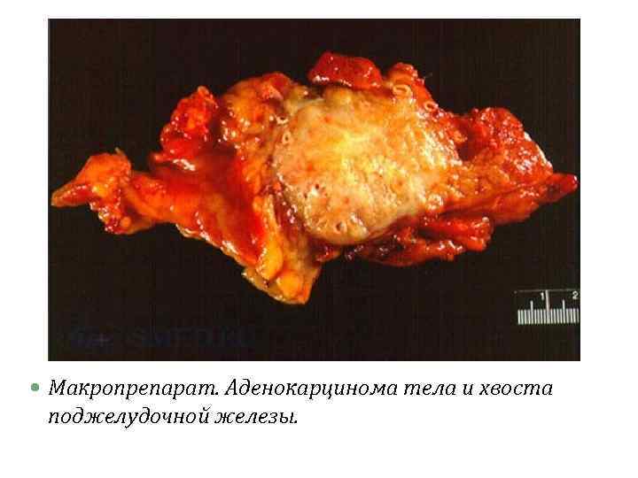  Макропрепарат. Аденокарцинома тела и хвоста поджелудочной железы. 
