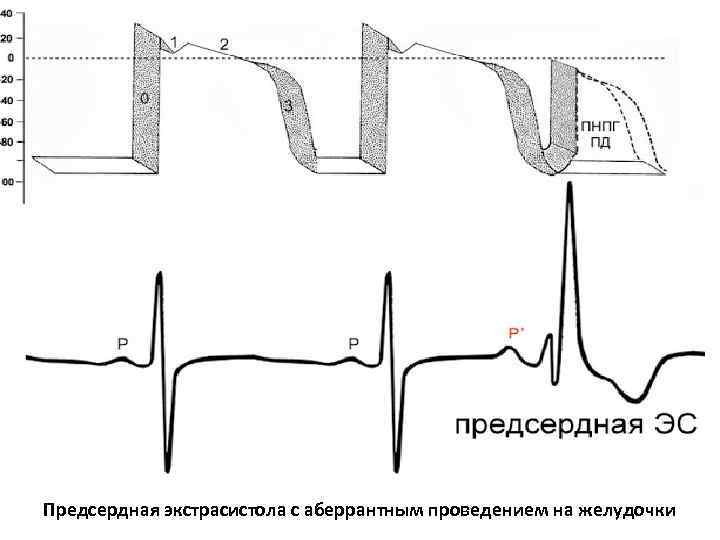 Предсердная экстрасистола с аберрантным проведением на желудочки 