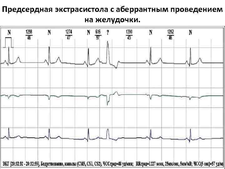 Предсердная экстрасистола с аберрантным проведением на желудочки. 