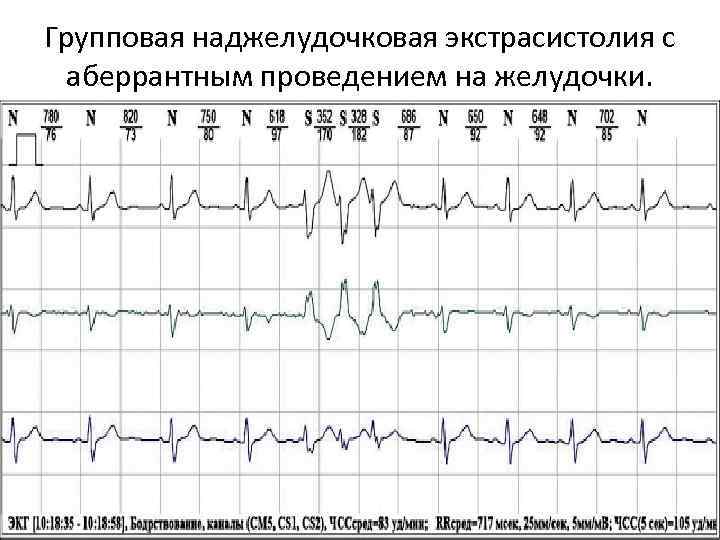 Групповая наджелудочковая экстрасистолия с аберрантным проведением на желудочки. 