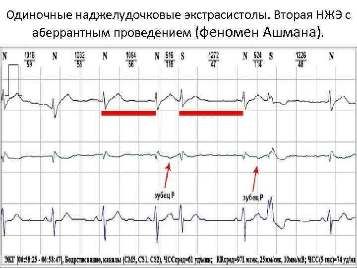 Одиночные наджелудочковые экстрасистолы. Вторая НЖЭ с аберрантным проведением (феномен Ашмана). 