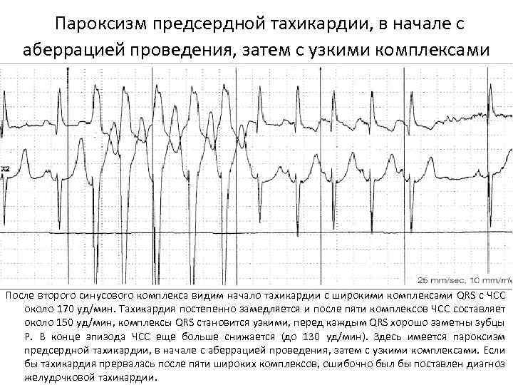  Пароксизм предсердной тахикардии, в начале с аберрацией проведения, затем с узкими комплексами После