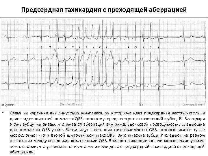 Предсердная тахикардия с преходящей аберрацией • Слева на картинке два синусовых комплекса, за которыми