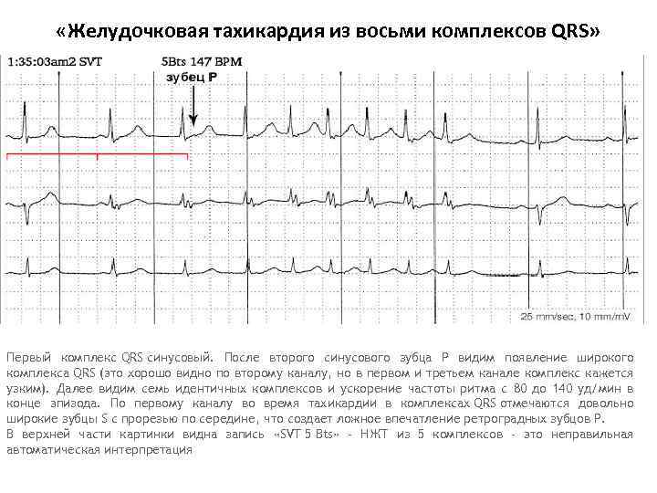  «Желудочковая тахикардия из восьми комплексов QRS» Первый комплекс QRS синусовый. После второго синусового