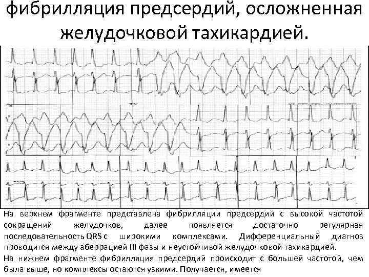 фибрилляция предсердий, осложненная желудочковой тахикардией. На верхнем фрагменте представлена фибрилляции предсердий с высокой частотой