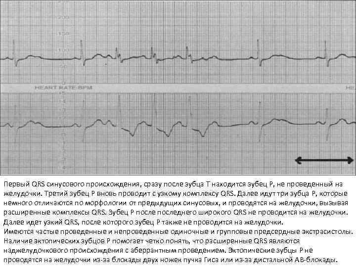 Первый QRS синусового происхождения, сразу после зубца Т находится зубец Р, не проведенный на