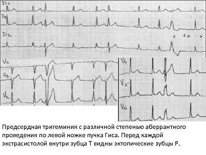 Предсердная тригеминия с различной степенью аберрантного проведения по левой ножке пучка Гиса. Перед каждой