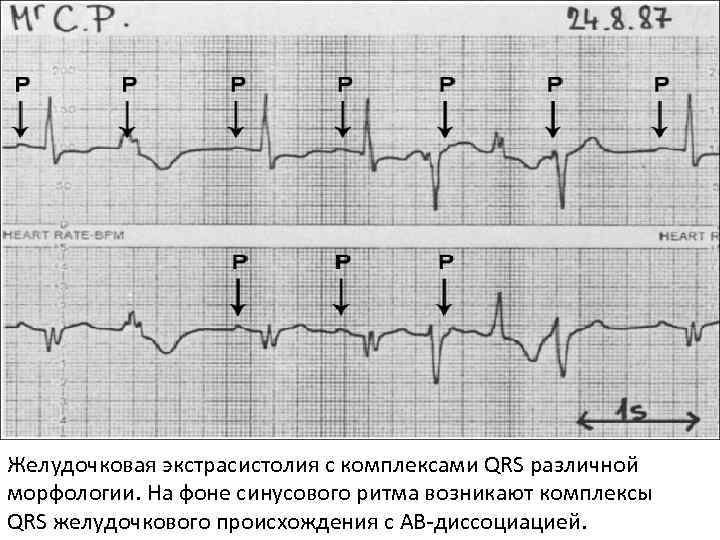 Желудочковая экстрасистолия с комплексами QRS различной морфологии. На фоне синусового ритма возникают комплексы QRS