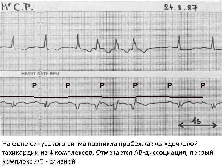 На фоне синусового ритма возникла пробежка желудочковой тахикардии из 4 комплексов. Отмечается АВ-диссоциация, первый