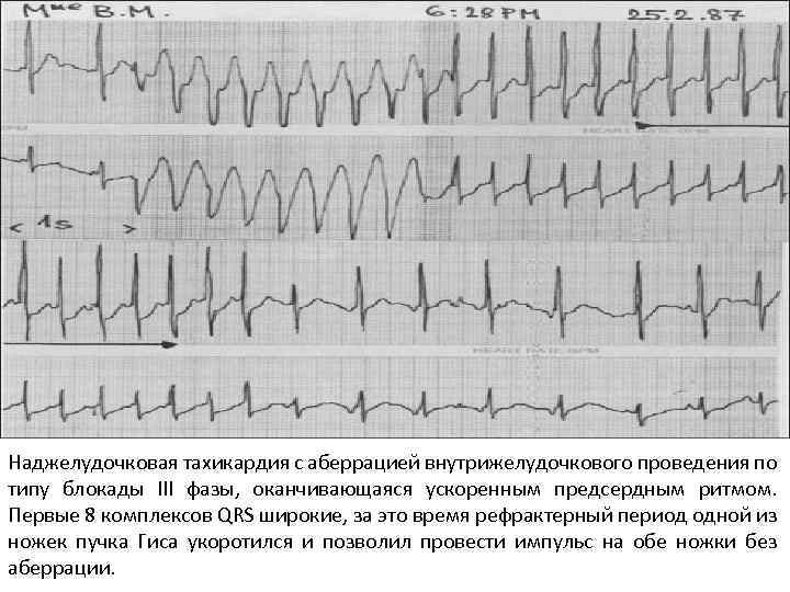 Наджелудочковая тахикардия с аберрацией внутрижелудочкового проведения по типу блокады III фазы, оканчивающаяся ускоренным предсердным