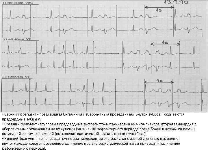  • Верхний фрагмент - предсердная бигеминия с аберрантным проведением. Внутри зубцов Т скрываются