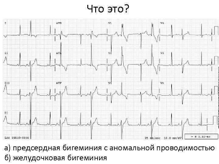 Что это? а) предсердная бигеминия с аномальной проводимостью б) желудочковая бигеминия 