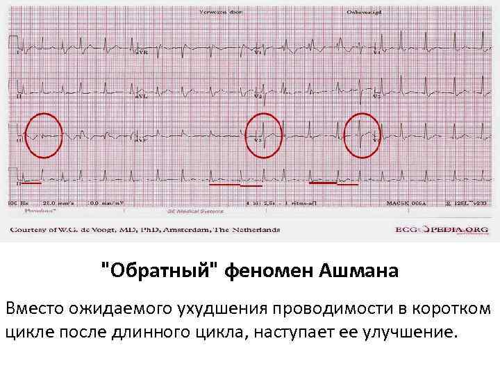 "Обратный" феномен Ашмана Вместо ожидаемого ухудшения проводимости в коротком цикле после длинного цикла, наступает