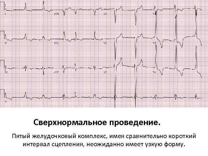 Сверхнормальное проведение. Пятый желудочковый комплекс, имея сравнительно короткий интервал сцепления, неожиданно имеет узкую форму.