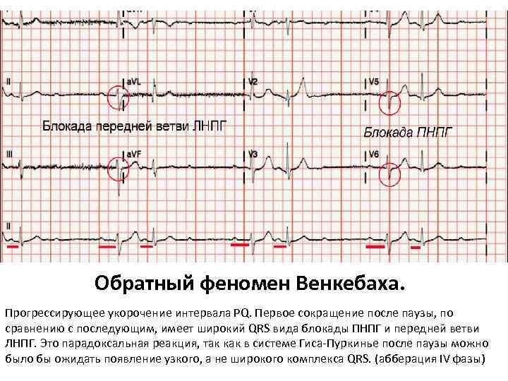 Обратный феномен Венкебаха. Прогрессирующее укорочение интервала PQ. Первое сокращение после паузы, по сравнению с