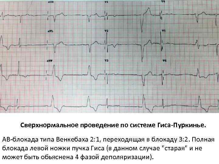 Сверхнормальное проведение по системе Гиса-Пуркинье. АВ-блокада типа Венкебаха 2: 1, переходящая в блокаду 3: