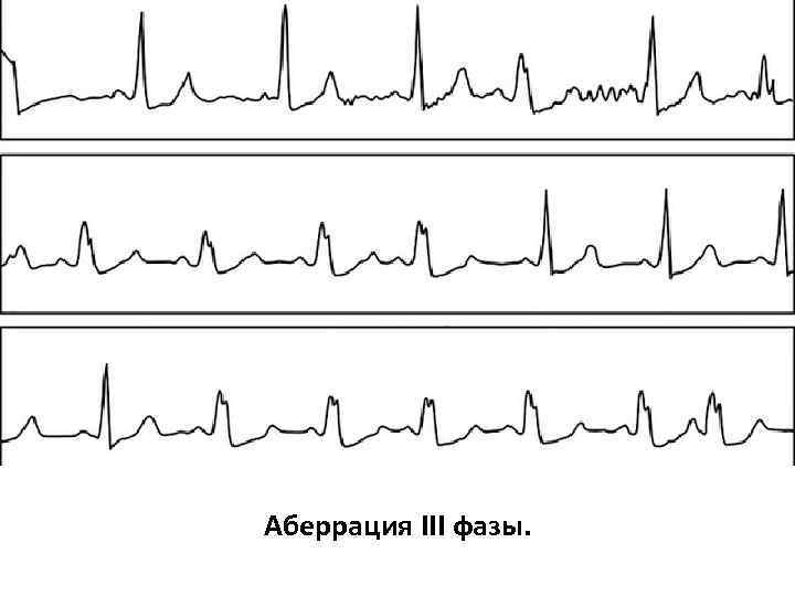 Аберрация III фазы. 