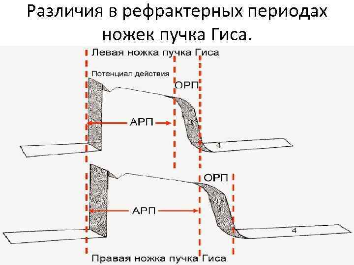 Различия в рефрактерных периодах ножек пучка Гиса. 