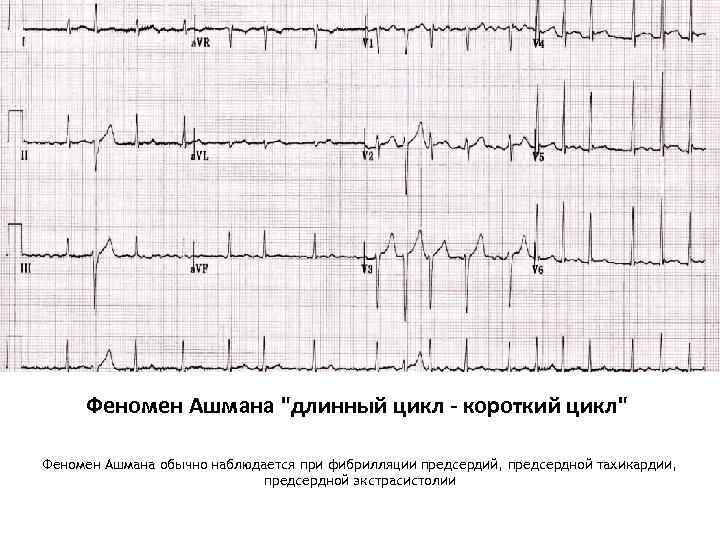 Феномен Ашмана "длинный цикл - короткий цикл" Феномен Ашмана обычно наблюдается при фибрилляции предсердий,