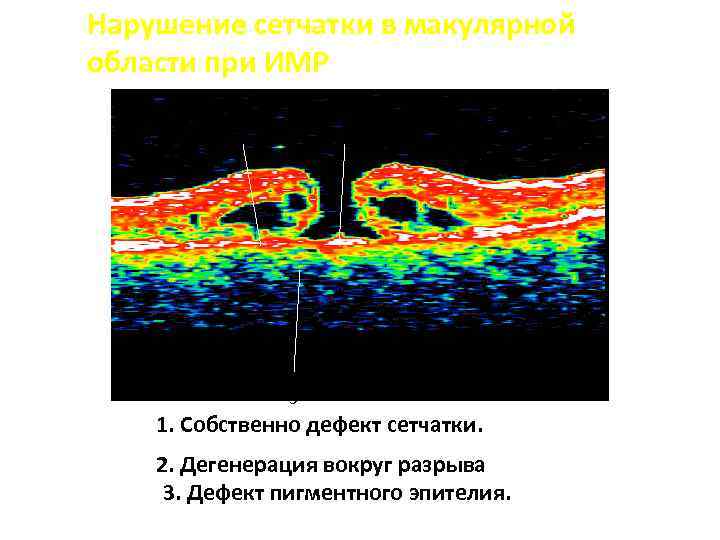 Нарушение сетчатки в макулярной области при ИМР 1 2 3 1. Собственно дефект сетчатки.