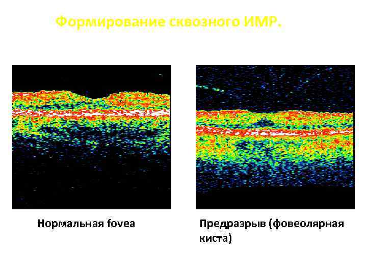 Фовеолярная гиперплазия. Очаговая фовеолярная гиперплазия. Фовеолярная активность.