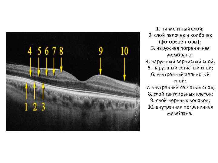 1. пигментный слой; 2. слой палочек и колбочек (фоторецепторы); 3. наружная пограничная мембрана; 4.