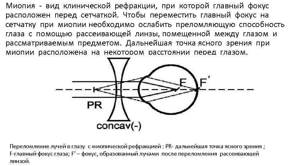 Миопия - вид клинической рефракции, при которой главный фокус расположен перед сетчаткой. Чтобы переместить