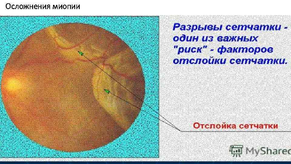 Осложнения миопии 