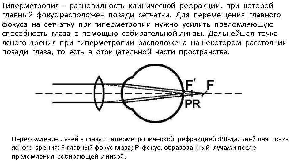 Гиперметропия - разновидность клинической рефракции, при которой главный фокус расположен позади сетчатки. Для перемещения