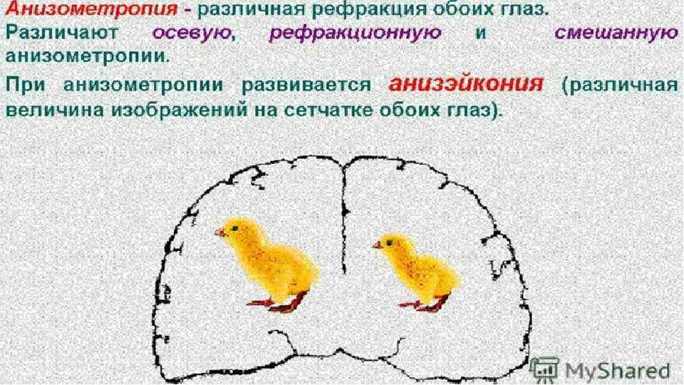 Анизометропия 