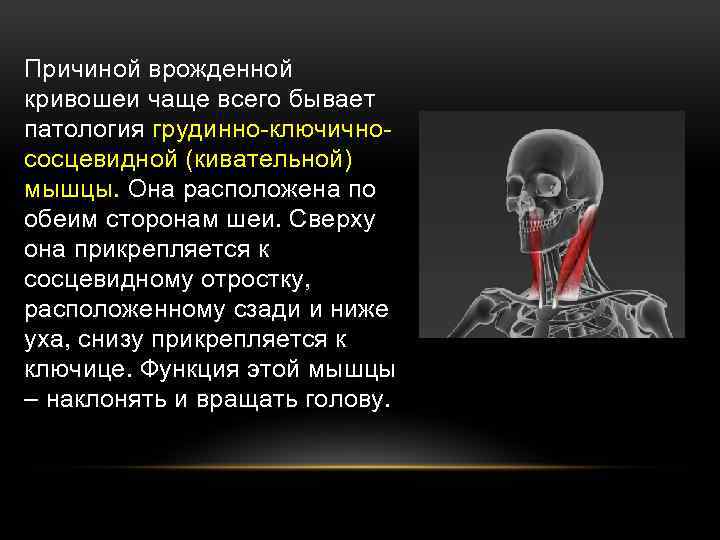 Причиной врожденной кривошеи чаще всего бывает патология грудинно-ключичнососцевидной (кивательной) мышцы. Она расположена по обеим