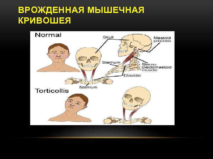 Кривошея презентация травматология