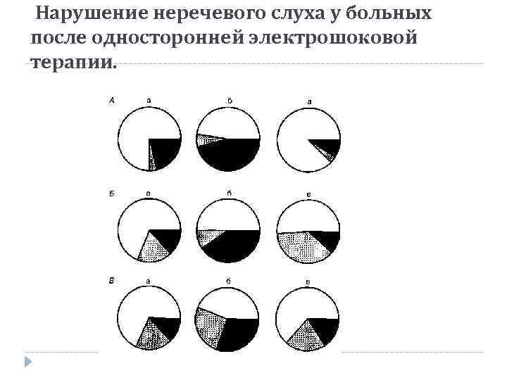  Нарушение неречевого слуха у больных после односторонней электрошоковой терапии. 
