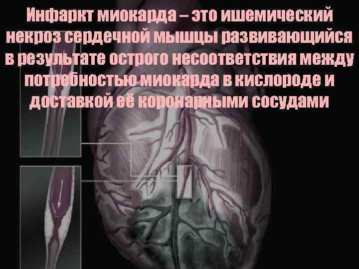 Инфаркт миокарда – это ишемический некроз сердечной мышцы развивающийся в результате острого несоответствия между