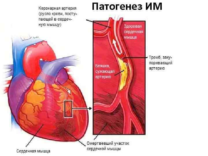 Патогенез ИМ 