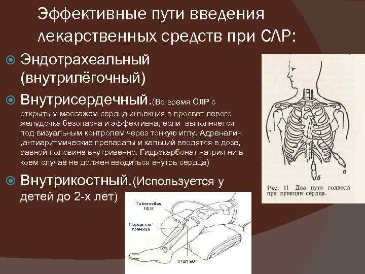 Эффективные пути введения лекарственных средств при СЛР: Эндотрахеальный (внутрилёгочный) Внутрисердечный. (Во время СЛР с