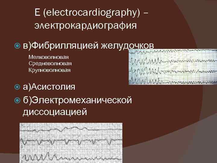 Е (еlесtrocardiography) – электрокардиография в)Фибрилляцией желудочков Мелковолновая Средневолновая Крупноволновая а)Асистолия б)Электромеханической диссоциацией 