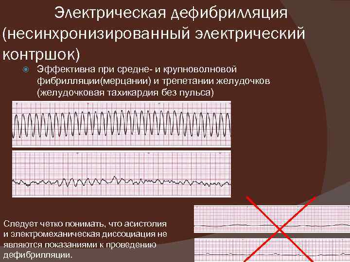 Электрическая дефибрилляция (несинхронизированный электрический контршок) Эффективна при средне- и крупноволновой фибрилляции(мерцании) и трепетании желудочков