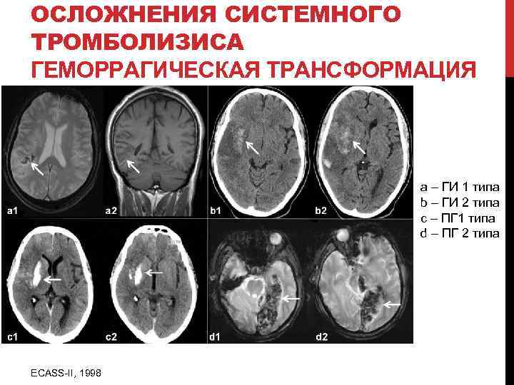 ОСЛОЖНЕНИЯ СИСТЕМНОГО ТРОМБОЛИЗИСА ГЕМОРРАГИЧЕСКАЯ ТРАНСФОРМАЦИЯ a – ГИ 1 типа b – ГИ 2