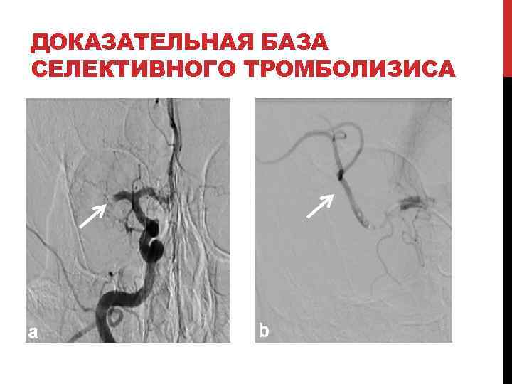 ДОКАЗАТЕЛЬНАЯ БАЗА СЕЛЕКТИВНОГО ТРОМБОЛИЗИСА 