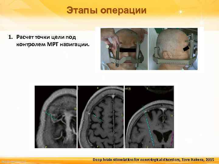 Этапы операции 1. Расчет точки цели под контролем МРТ навигации. http: //linda 6035. ucoz.