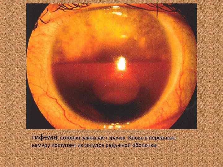 гифема, которая закрывает зрачок. Кровь в переднюю камеру поступает из сосудов радужной оболочки. 