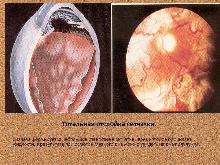 Тотальная отслойка сетчатки. Сначала формируется небольшое отверстие в сетчатке через которое проникает жидкости, в